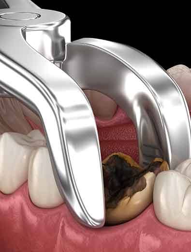 Illustration of a tooth being extracted